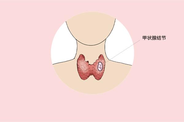 甲狀腺癌癥的主要癥狀表現(xiàn)有什么？為什么會得甲狀腺癌癥呢？